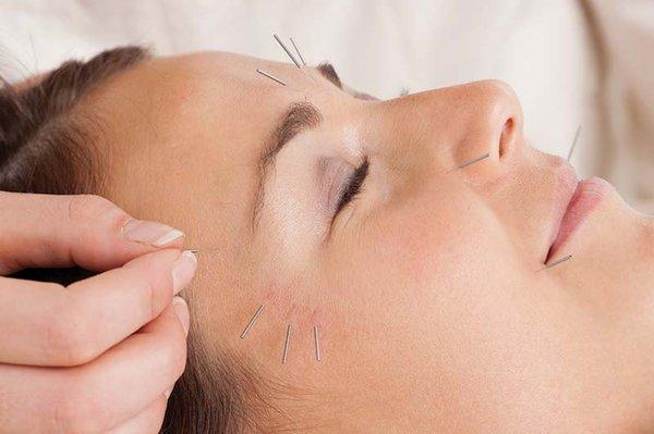 Cosmetic acupuncture