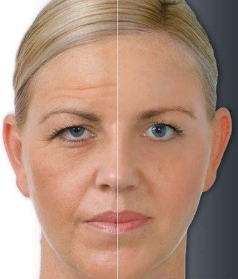 Before and after 6 treatments of "TITAN" face tightening,
 aka non-surgical face lift