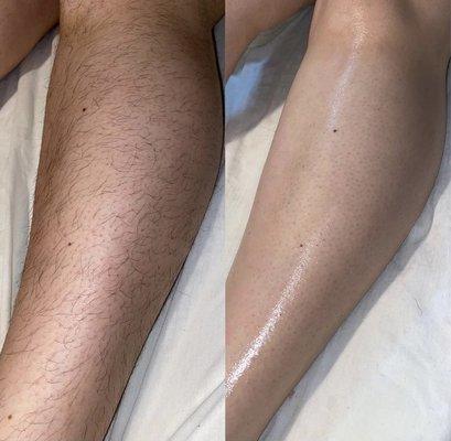 Full Leg Wax Before and After