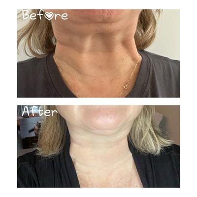 Neck bands treated with botox