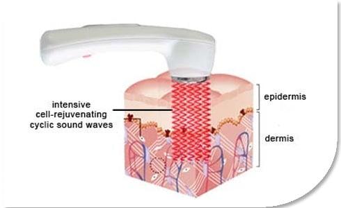 Ultrasound Anti-aging Facial by Professional Esthetician...Many SKINCARE services from head to toe.