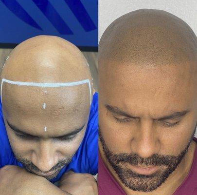 SMP Scalp Micropigmentation