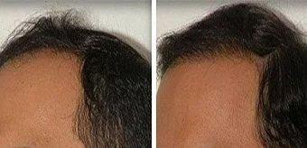 Dr. Simon of Vegas Valley Hair Restoration - Before and After photo