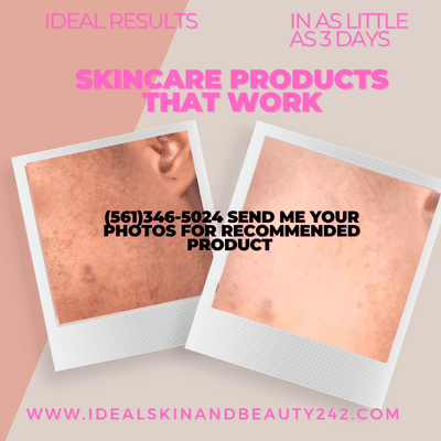 #idealskinandbeauty removes dark marks dark spots stretch marks as well as lightens the skin