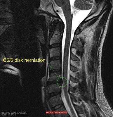 MRI of a herniated cervical disc at the C5-6 level causing neck pain with numbness, tingling, and pain in the arm