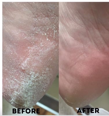 Real results with one treatment! LCN Urea Pedicure