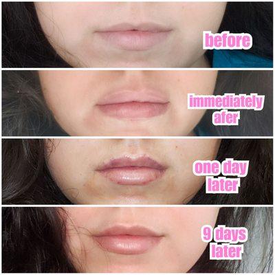 Lips progression photo