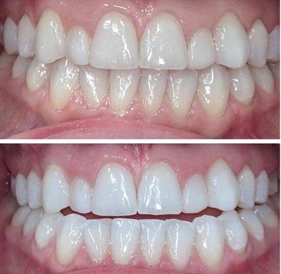 Teeth whitening lifts stains.