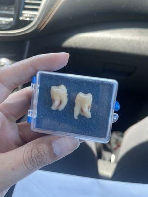 Wisdom Teeth