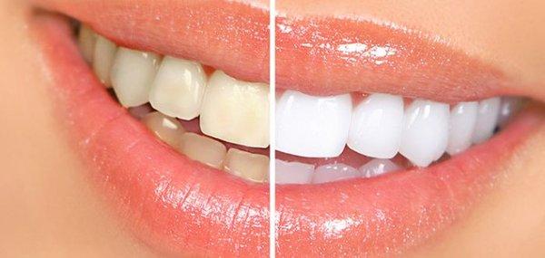 Whitening done in our office