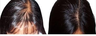 Before & After Hair Regrowth Serum