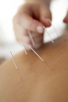 Ease Into Acupuncture