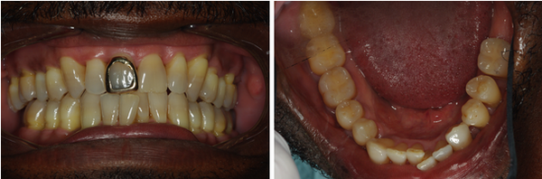 Ricky had severe crowding of his lower teeth.  Please note the overlap of his central  incisors which Dr...