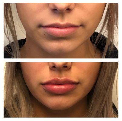 Lip flip aka lip fillers, loved the results.