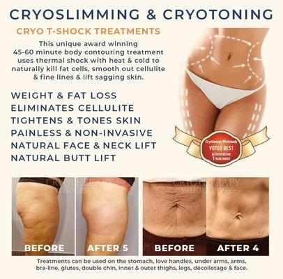 CryoSlimming & CryoToning