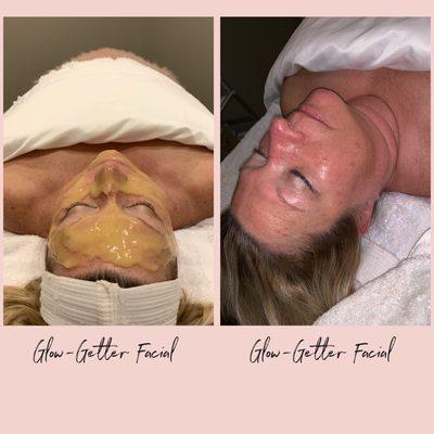 GLOW-GETTER Facial! During & after! The skin is immediately left exfoliated and hydrated