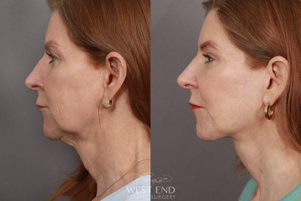 Dr. Ruff performed a Deep Plane Facelift & Neck Lift, Brow Lift, Upper Eyelid Lift, Fat Grafting, and CO2 Resurfacing.