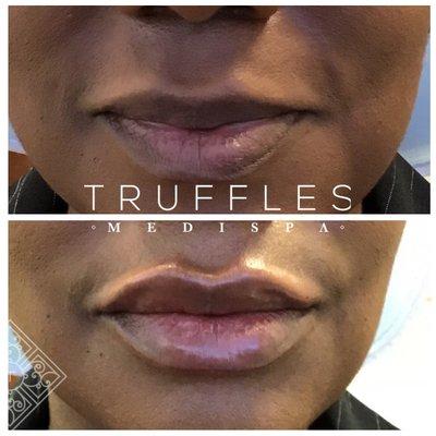 Restlyane lips before and after