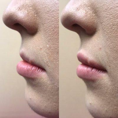 Lip augmentation for profile improvement before & after