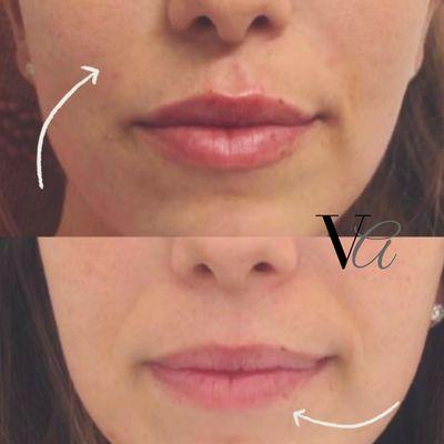 Lips and Laugh lines softened with Dermal Fillers