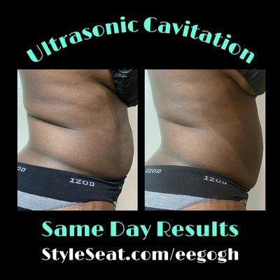 Body Contouring Fat Cavitation