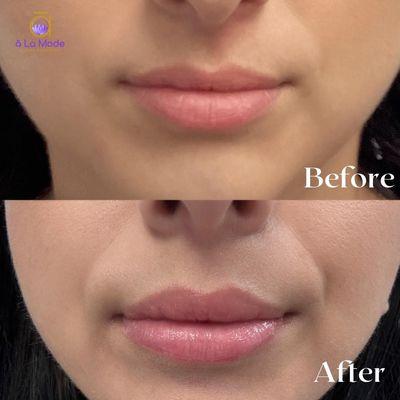 Unlocking a radiant smile: Before and after a lip flip transformation, where subtle changes make all the difference.