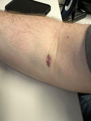 Horrific bruising and burst vein after multiple unprofessional blood draw attempts.