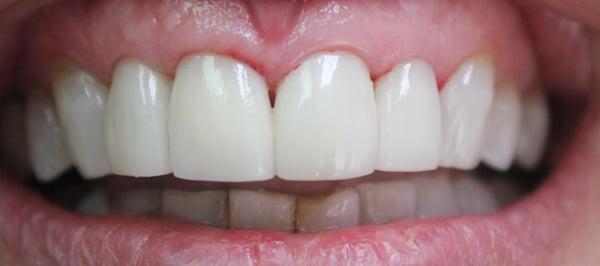 After veneers