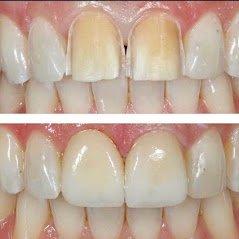 Before and After at NÜVA Smile | Clifton, NJ