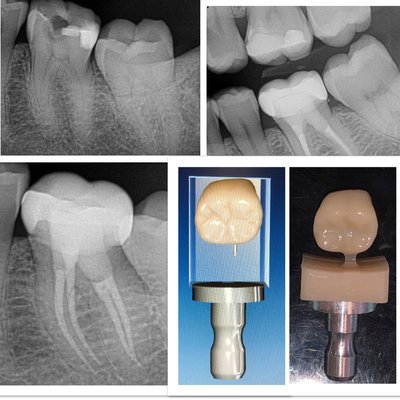 Root canal, Cerec Porcelain Crown. 718 575-0060