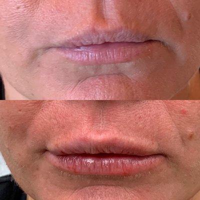 Restylane Kysse lip filler