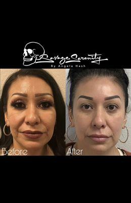 Full face rejuvenation with RHA filler.