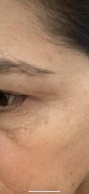 After picture of crows feet