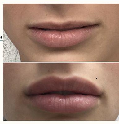 Lip filler