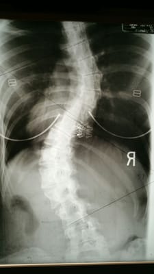 Severe scoliosis. Treatment eliminated symptoms and minimized progression.