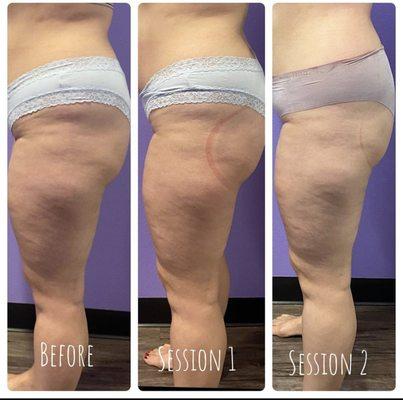 Results of Cellulite Treatment with Wood Therapy