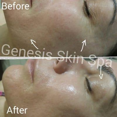 Micropen (Collagen Induction Therapy)