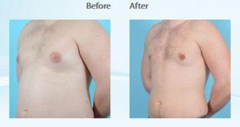 Breast Reduction-Patient #10681 Frontal Before & After