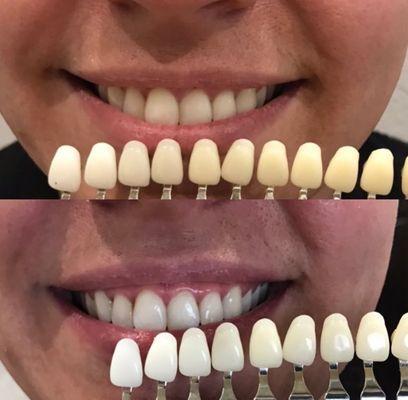 We also offer teeth whitening services using natural & sensitive ingredients so you can brighten your smile the pain free way!