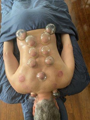 Cupping to the rescue