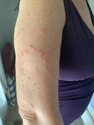 Bedbug bites from the Patriot Inn.