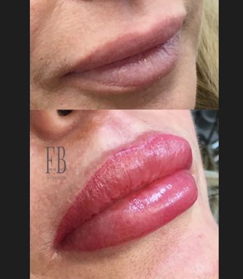 Ombré Lips - Immediately After lips will temporarily be swollen this will dissipate over a few days as your lips heal .