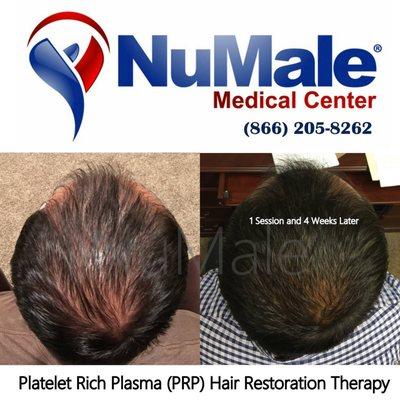 Platelet Rich Plasma (PRP) Hair Restoration Therapy for Men. NuMale Medical Center