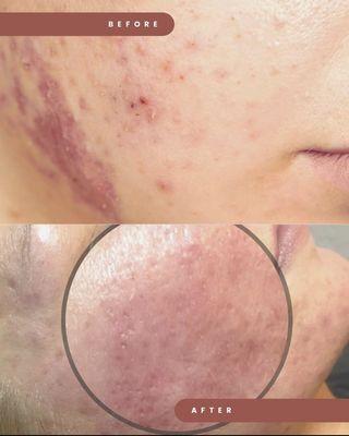 Collagen induction helps with acne scarring.