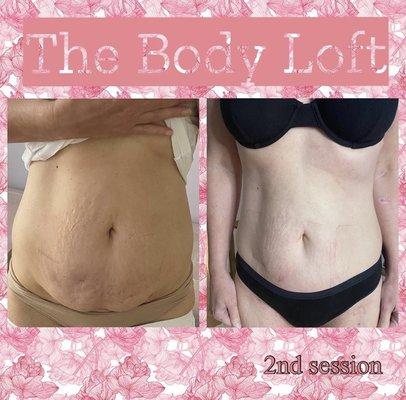 This photo was taken after client's second session with laser lipo and body cavitation.