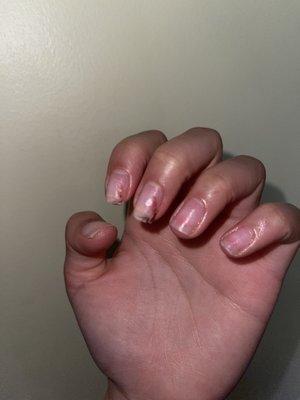 Broken nail and bleeding nail