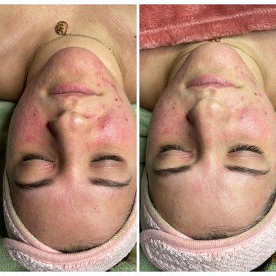 Microneedling with LED Light Therapy