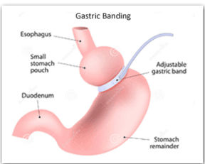 Gastric Banding