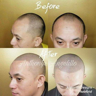 We offer scalp micropigmentation treatment for hairloss, baldness.