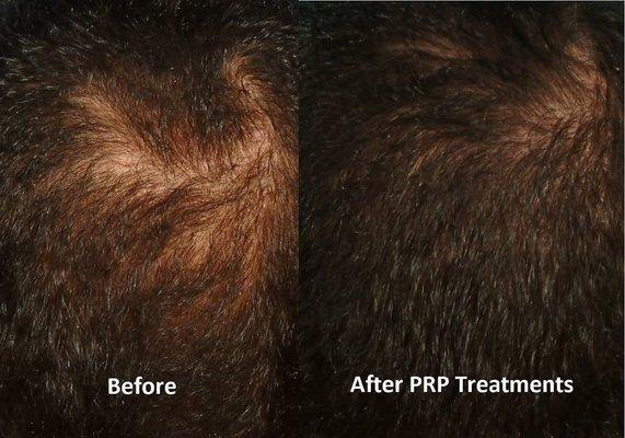 Hair growth using Platelet Rich Plasma from your own blood!